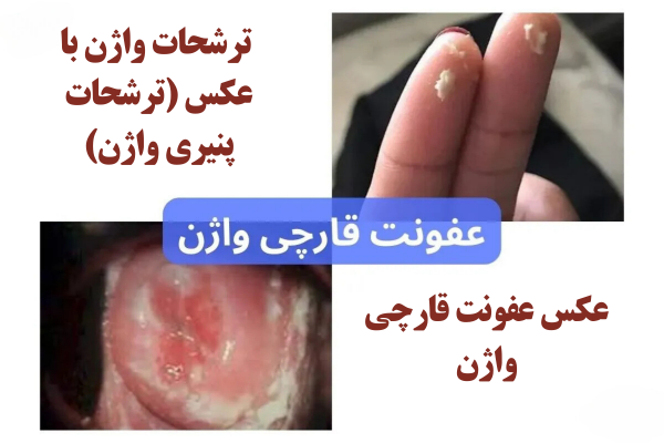  عکس انواع عفونت واژن قارچی