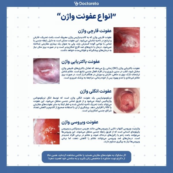  عکس عفونت مخمری واژن