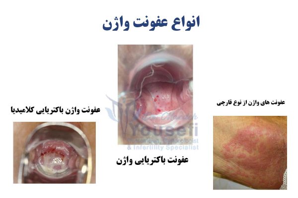  عکس عفونت مخمری واژن