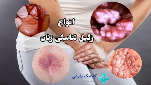  عکس زگیل تناسلی در مردان
