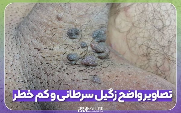  عکس زگیل تناسلی در مردان