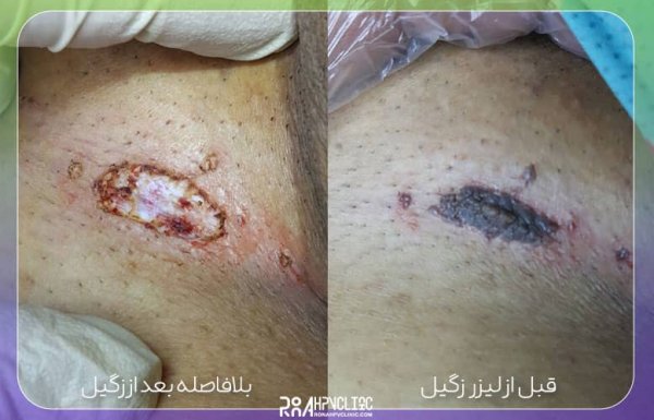  عکس زگیل تناسلی در مردان