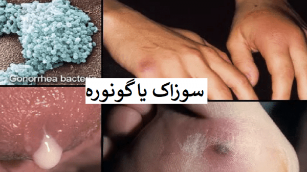  عکس زگیل تناسلی نوع ۱۶