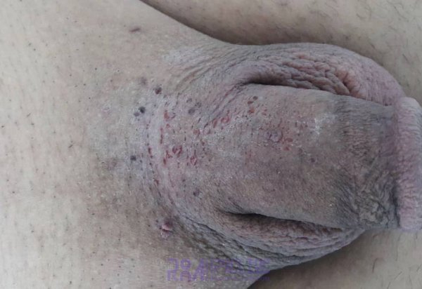  عکس واضح از زگیل تناسلی زنان نی نی سایت