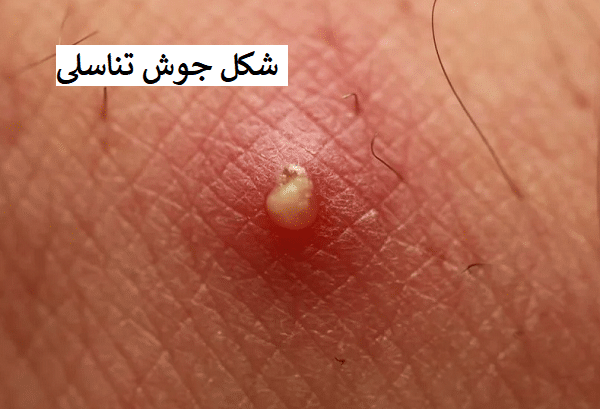 عکس زگیل تناسلی در زنان