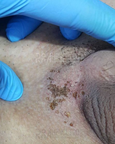 عکس زگیل تناسلی نوع ۱۶