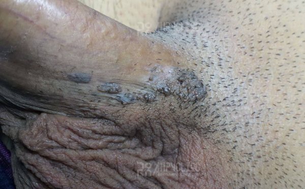 عکس زگیل تناسلی نوع ۱۶