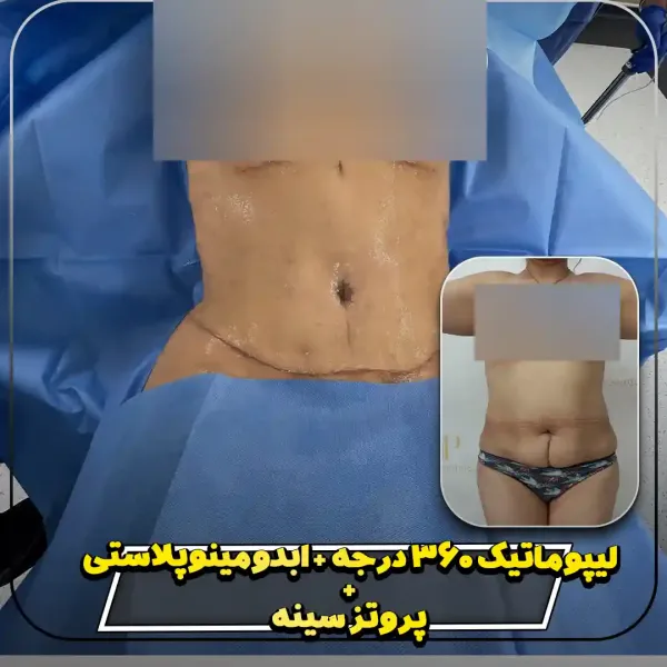  عکس قبل و بعد لاغری شکم
