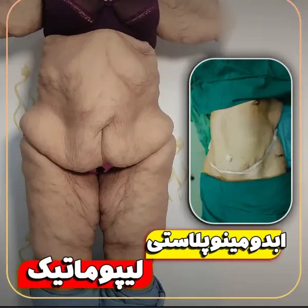  عکس قبل و بعد لاغری شکم