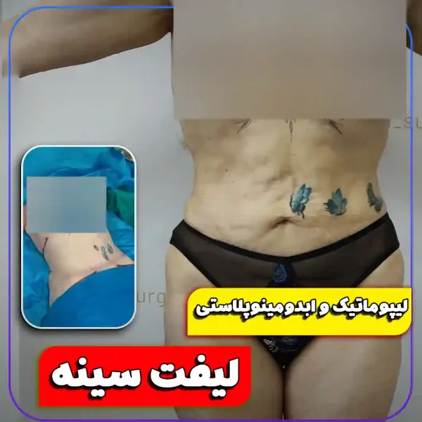  عکس قبل و بعد لاغری شکم