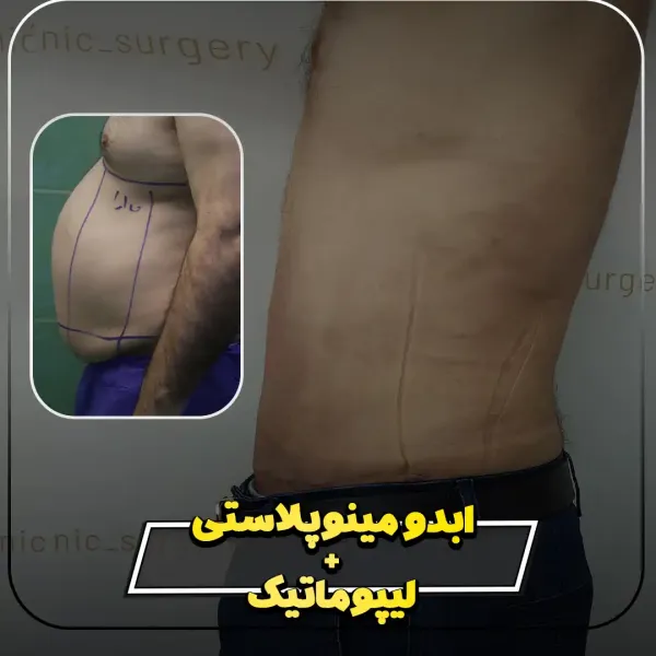 عکس قبل و بعد لاغری شکم