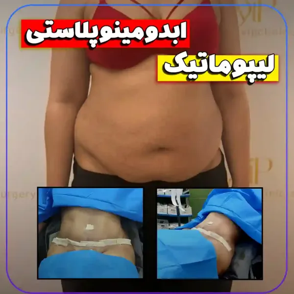  عکس قبل و بعد لاغری شکم