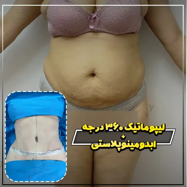 عکس قبل و بعد ساکشن شکم و پهلو