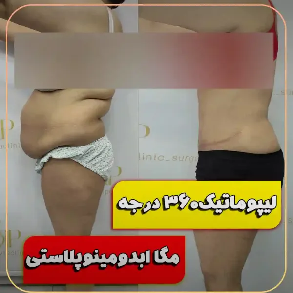  عکس قبل و بعد ساکشن شکم و پهلو