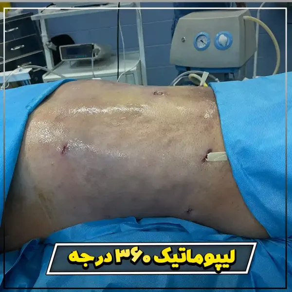  عکس قبل و بعد ساکشن شکم و پهلو