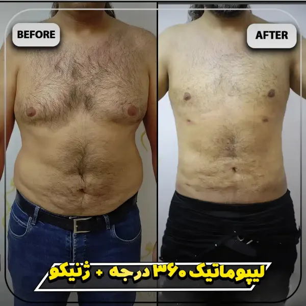  عکس قبل و بعد ساکشن شکم و پهلو