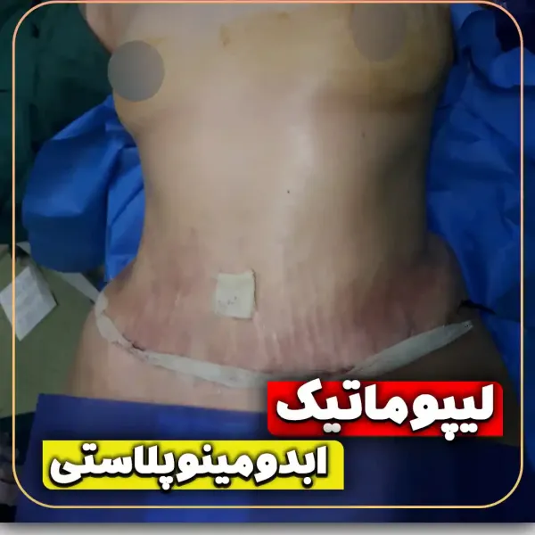  عکس جراحی شکم زن