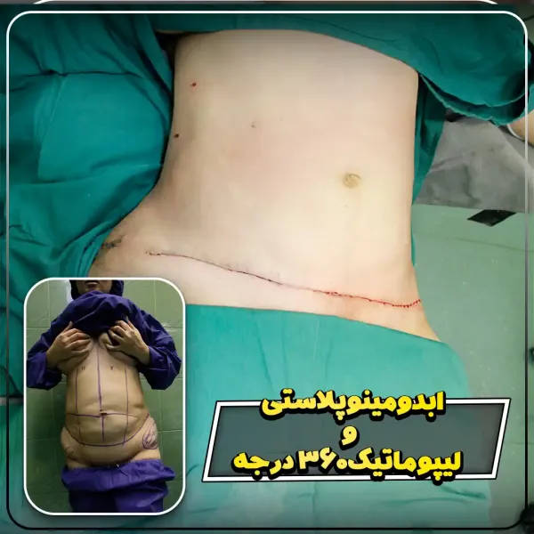  عکس جراحی شکم زن