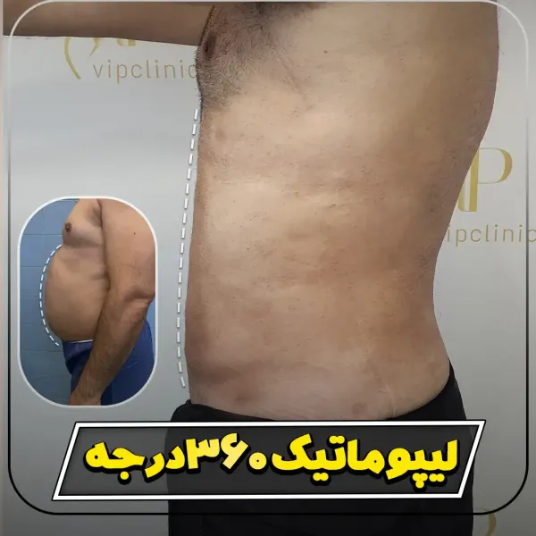  عکس قبل و بعد لیپوماتیک شکم