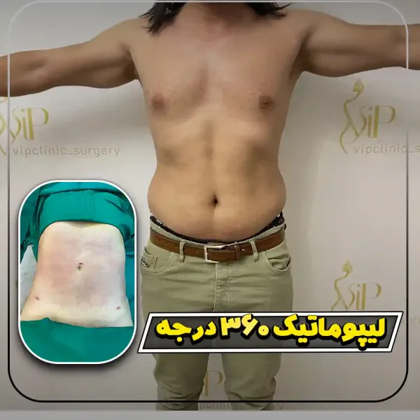  عکس قبل و بعد لیپوماتیک شکم