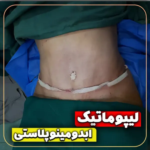  عکس قبل و بعد لیپوماتیک شکم