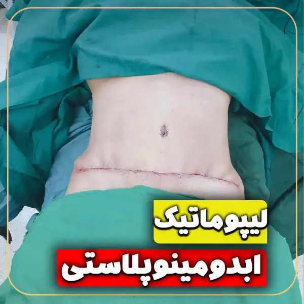  عکس قبل و بعد لیپوماتیک شکم