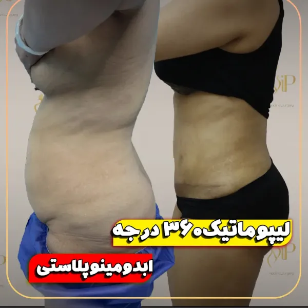  عکس قبل و بعد لیپوماتیک شکم