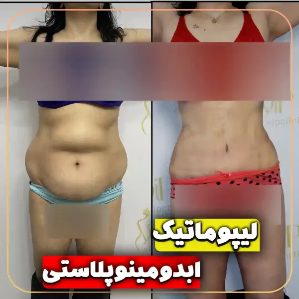عکس بعد از عمل ابدو