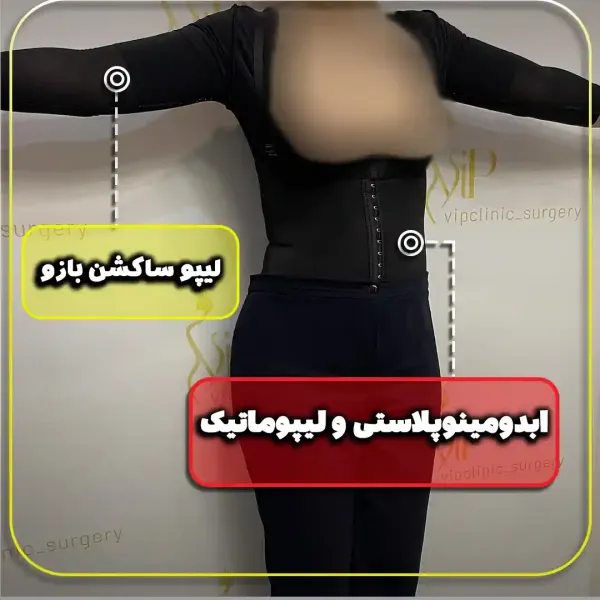  عکس بعد از عمل ابدو
